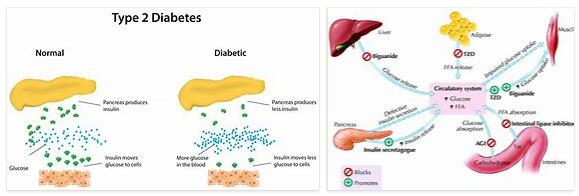 Diabetes Mellitus Type 2